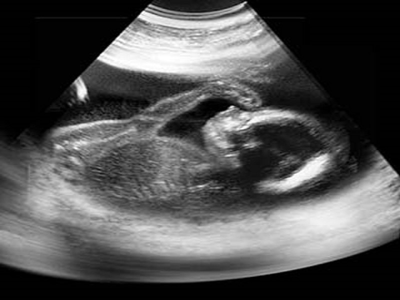 سونوگرافی در هفته بیستم بارداری