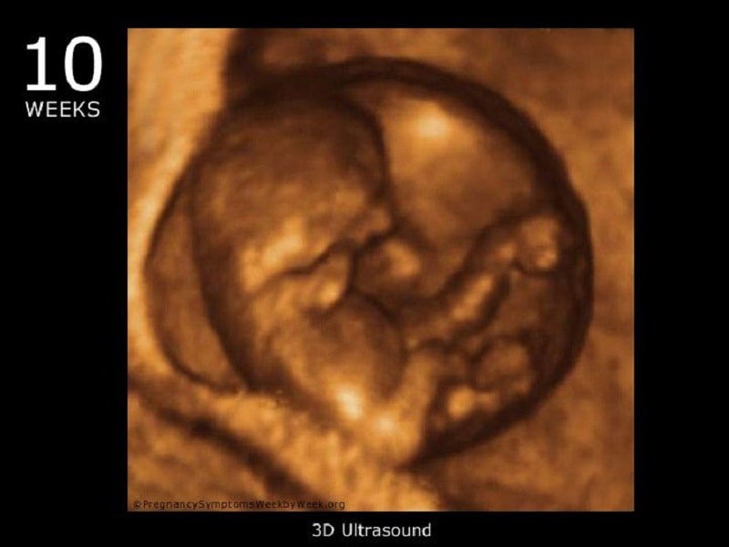 سونوگرافی در هفته دهم بارداری