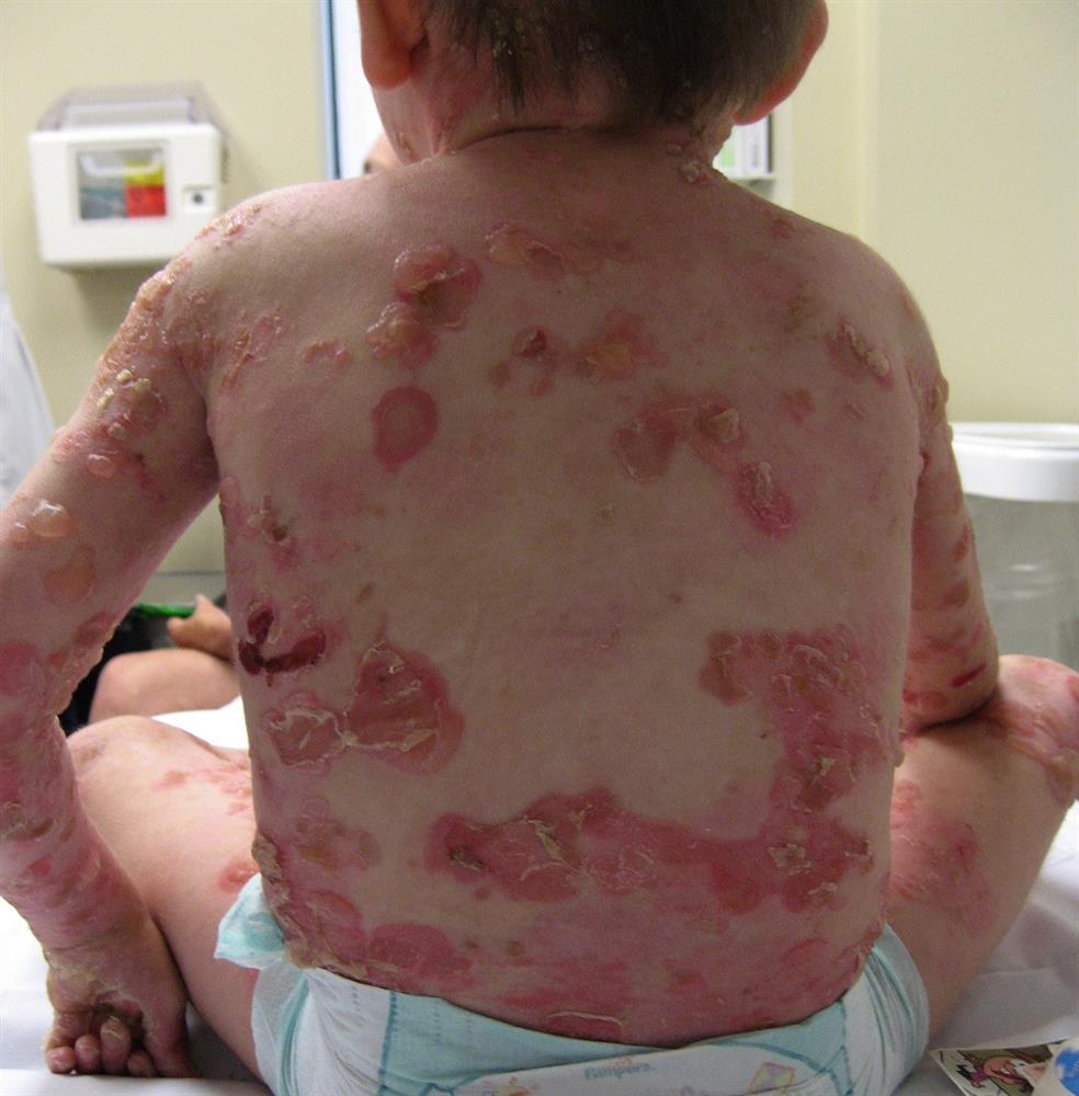 علت بروز بیماری پروانه ای در کودکان